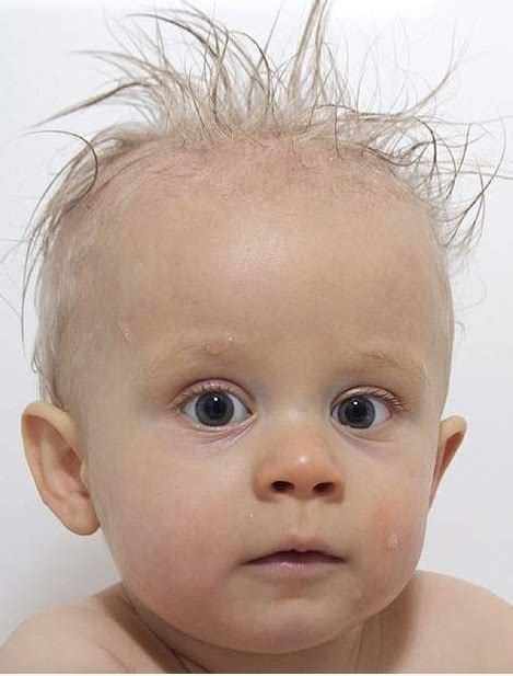 Newborn Baby hair loss causesNewborn Babies Natural Care