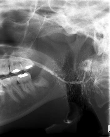 Parotitis — parotìtis m definicija pat. Chronic Obstructive Parotitis Due to Strictures of Stenson ...