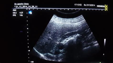 Large Renal Stone Ultrasound Youtube