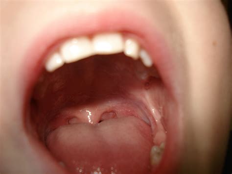 Scalloped Tongue: What You Need to Know | Tripboba.com