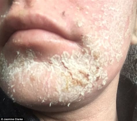 Edinburgh Woman Suffers From Excruciating Skin Condition Daily Mail