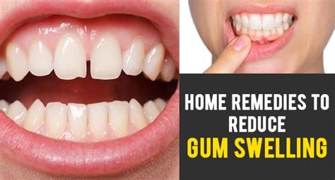 Home Remedies To Reduce Gum Swelling Remedies Lore