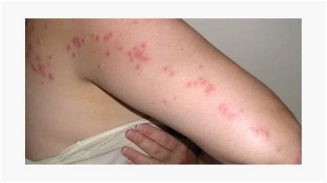 Spider Bite Allergic Reaction Rash