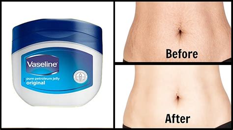 How To Apply Vaseline And Aloe Vera Gel Get Rid Of Stretch Marks At