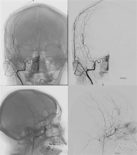 Trauma Direct Cavernous Carotid Fistula Multiple Sinus Compartments