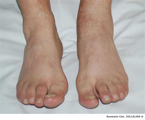 Reactive Arthritis After The Intravesical Instillation Of Bcg