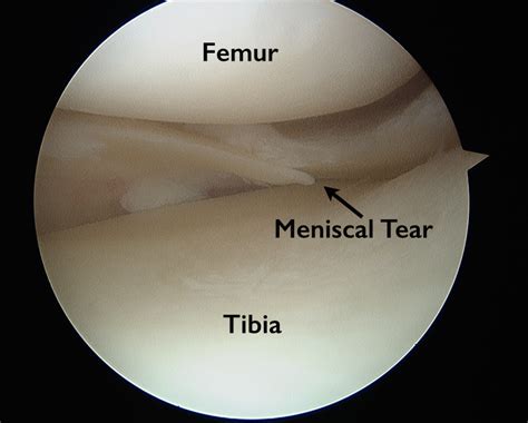 Torn Meniscus Anatomy And Causes Video Town Center Orthopaedics