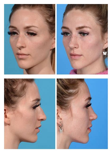 Rhinoplasty With Dorsal Hump Before And After Photos