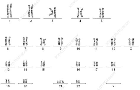Downs Syndrome Karyotype Female Stock Image C0030953 Science Photo Library