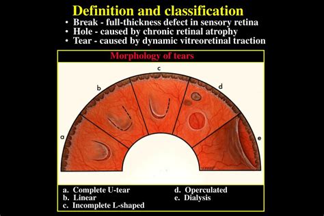 Ppt Introduction To Retinal Detachment Rd Powerpoint