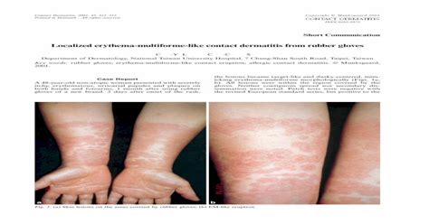 Localized Erythema Multiforme Like Contact Dermatitis From Rubber