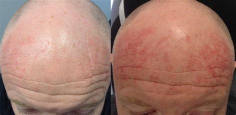 Efudex 5 Fluorouracil Actinic Keratosis Forehead 1 2 Reaction