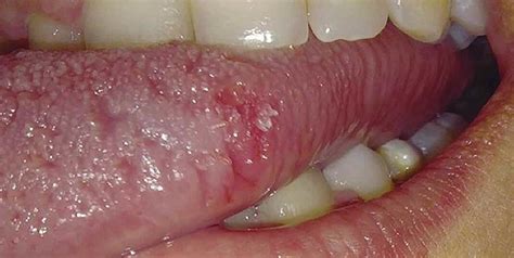 Papiloma Oral Lesión Exofítica De Base Sésil En Margen Lateral De