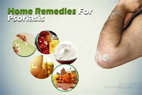 Top 20 Natural Home Remedies For Psoriasis That Work