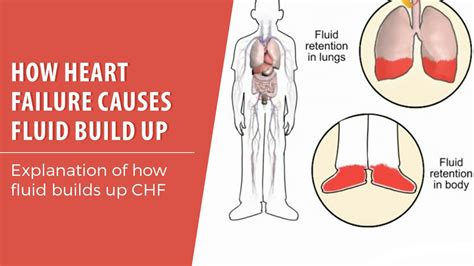 How Heart Failure Causes Fluid Build Up Advanced Cardiology Of