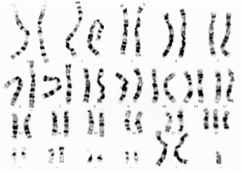 Figure 2 From Double Aneuploidy Trisomy 18 And Xxy In A Boy