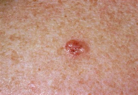 Skin Cancer Warning Signs What Skin Cancer Looks Like