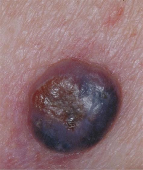 Pigmented Nodular Melanoma