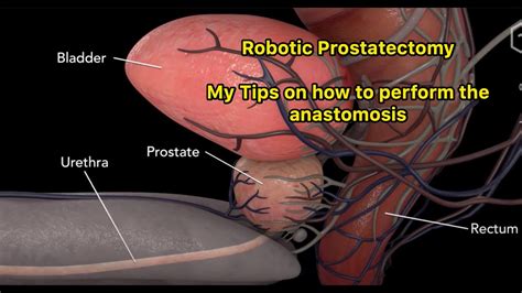 How To Complete An Anastomosis At Robotic Radical Prostatectomy Youtube