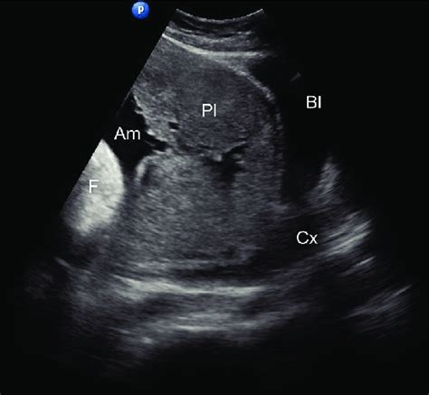 Midsagittal Ultrasound Scan Of The Lower Abdomen During Late Third