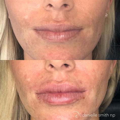 Lip Augmentation With Juvederm Danielle Smith NP Injected Syringes Of Juvederm Ultra Plus Over