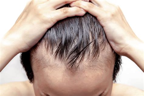 The Truth About Balding And What You Can Do About It The Mailroom