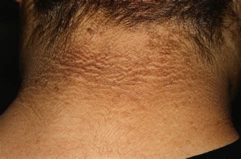 Acanthosis Nigricans Causes Symptoms Treatment