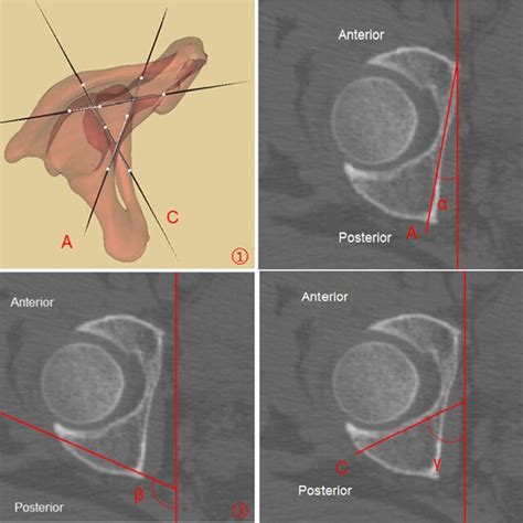 Measurement Of Angles Between The Sagittal Plane And The Three Lateral