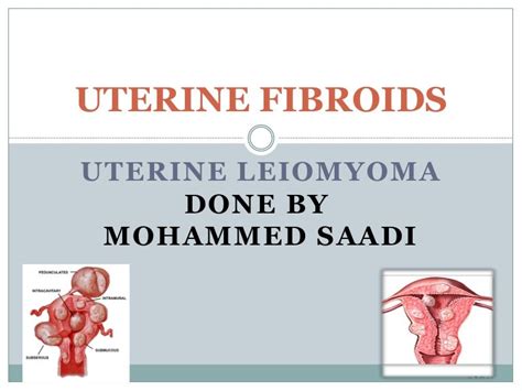 Uterine Fibroid Leiomyoma And New Treatment Modalities