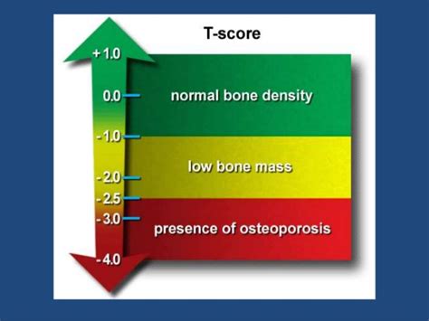 Therapy, regardless of the nature of the intervention or intervention(s) such as drug bone mineral density after prolonged electrically induced cycle training of paralyzed. Bone mineral density (bmd) test
