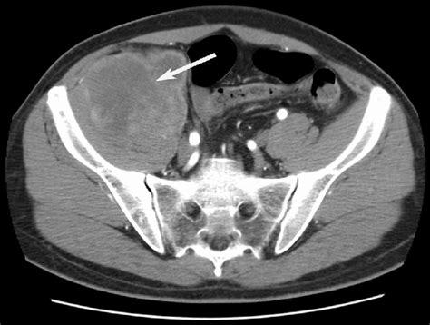 Preoperative Pelvic Ct Scan Of The Patient The Arrow Indicates Primary
