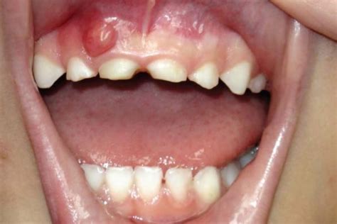 It started out two days ago as a small white spot, and i thought she was finally getting a top tooth. A Gum boil in child | Remedies, Gum, Treatment