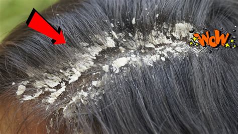 Long Hair Extremely Damaged Best Dandruff And Huge Flakes Scratching