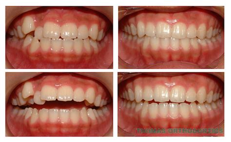 What To Expect Before And After Braces Thomas Orthodontics