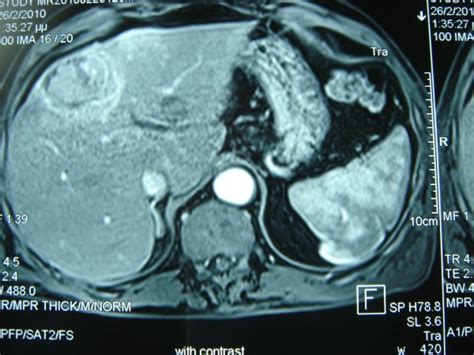 Abdominal Mri Scan Abdominal Mri Scan Showing The Tumor At Segment Iv