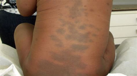 Birthmarks Causes Types And Treatments