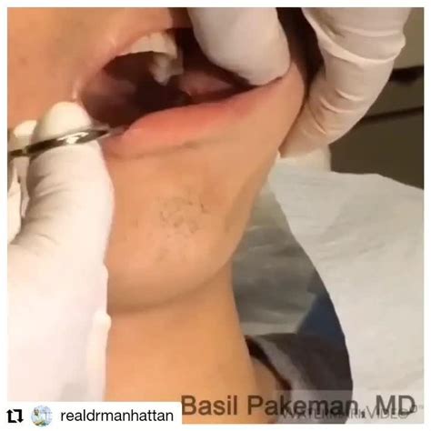 Buccal Fat Pad Removal Surgery GRAPHIC Video RealSelf