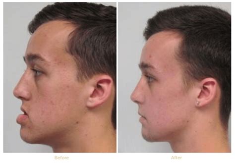 Reconstructive And Orthognathic Surgery Dr Anthony Farole Dmd Facial