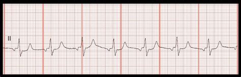 Float Nurse: Practice EKG Rhythm Strips 179