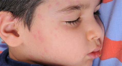 Hives Urticaria Triggers Causes Types Symptoms Diagnosis And Treatment