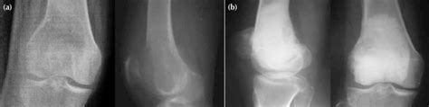 A Pre And B Post Operative Radiographs Showing A Giant Cell Tumour
