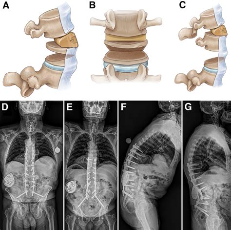 The Comprehensive Anatomical Spinal Osteotomy And Anterior Column