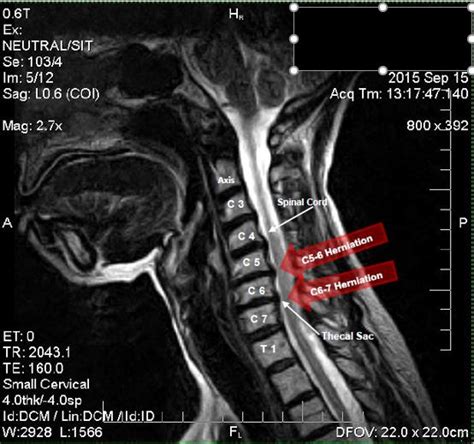 Herniated Disc Settlements From Car Accidents And More