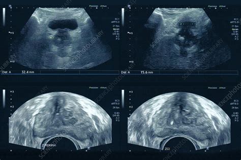 Prostate Pelvic Ultrasound Stock Image C Science Photo