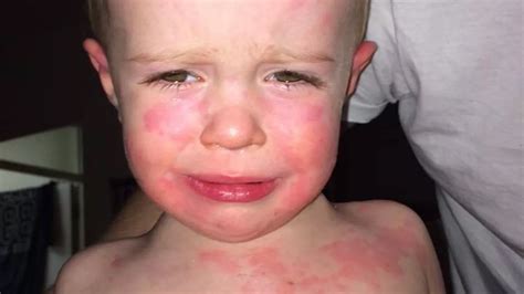 Baby With Scarlet Fever Was Turned Away From Hospital Three Times