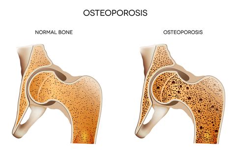 What Is Osteopenia