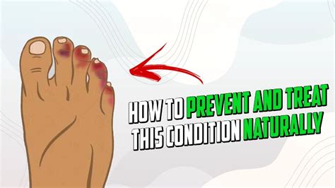 How To Stop Chilblains Naturally Youtube