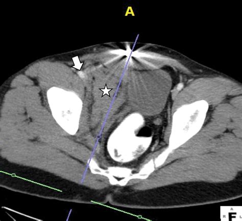 Multidetector Ct For Penetrating Torso Trauma State Of The Art Radiology