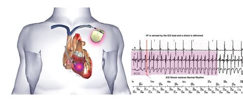 Implantable Cardioverter Defibrillator Icd One Heart Cardiology