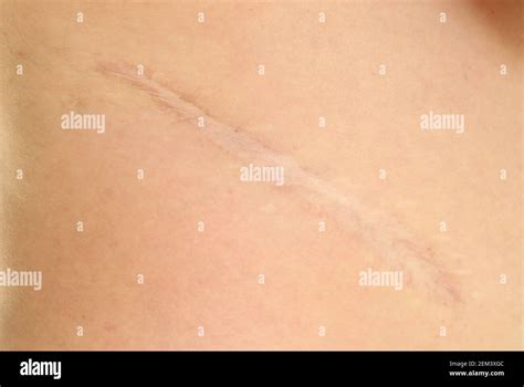 Kidney Operation Scar Hi Res Stock Photography And Images Alamy